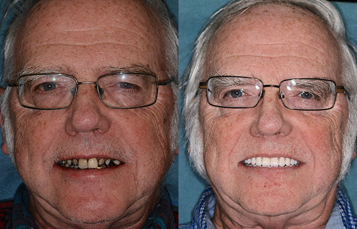 HZA™ --🦷Advanced Customized Full Denture Set🦷 (⏰Limited time discount last 30 minutes⏰)