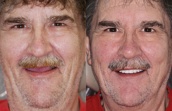 HZA™ --🦷Advanced Customized Full Denture Set🦷 (⏰Limited time discount last 30 minutes⏰)