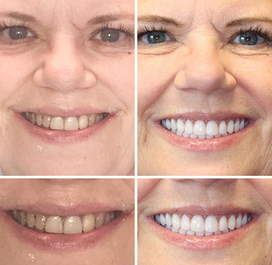 HZA™ --🦷Advanced Customized Full Denture Set🦷 (⏰Limited time discount last 30 minutes⏰)
