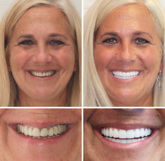 HZA™ --🦷Advanced Customized Full Denture Set🦷 (⏰Limited time discount last 30 minutes⏰)