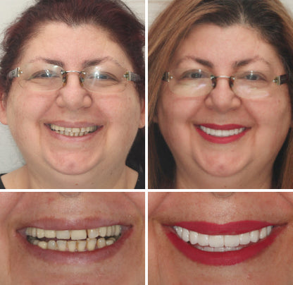 HZA™ --🦷Advanced Customized Full Denture Set🦷 (⏰Limited time discount last 30 minutes⏰)